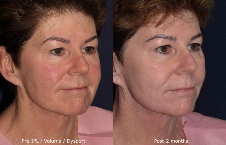 Before and after oblique image of IPL, Voluma and Dysport treatment on a female's face performed by Dr. Fabi at our San Diego medical spa