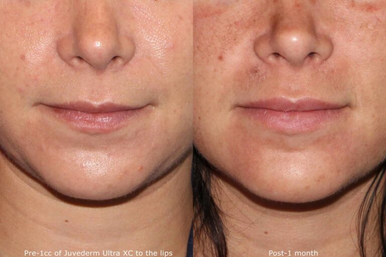Before and after front image of Juvederm Ultra treatment on a female's lips performed by Dr. Groff at our San Diego medical spa