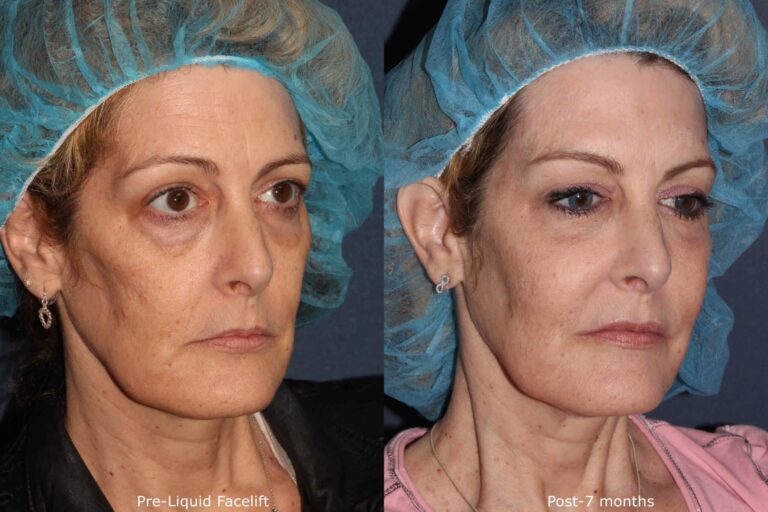 Before and after oblique image of dermal fillers and Botox treatment on a female's face performed by Dr. Wu at our San Diego medi spa