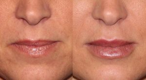 Images showing results before and after liquid facelift which removed lip wrinkles, San Diego, CA.