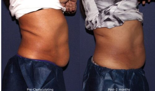 Before and after comparison of male patient following body sculpting in San Diego