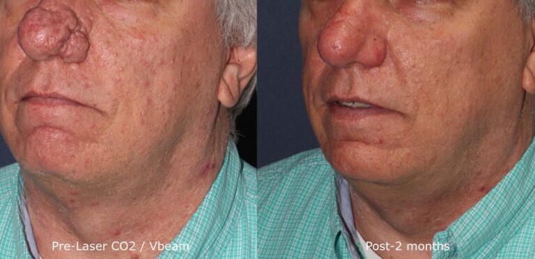 Before and after oblique image of Vbeam and CO2 laser treatment on a male's nose performed by Dr. Groff at our San Diego medical spa