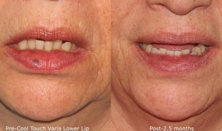 Before and after front image of CoolTouch Varia treatment on a female's lips performed by Dr. Groff at our San Diego medical spa