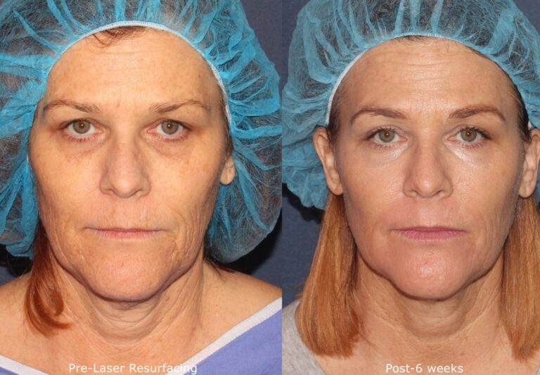 Before and after front image of laser resurfacing treatment on a female's face performed by Dr. Fabi at our San Diego medical clinic