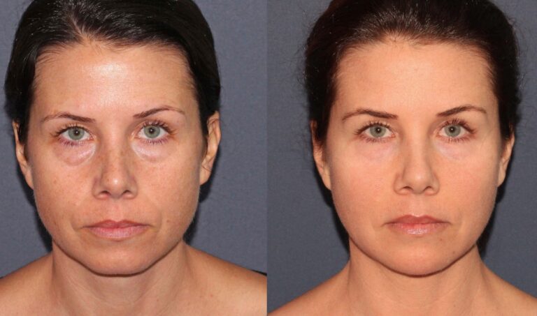 Before and after front image of Voluma, Botox and CO2 laser treatment on a female's face performed by Dr. Fabi at our San Diego medical spa