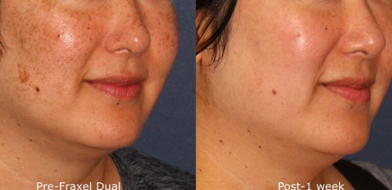 Before and after oblique image of Fraxel Dual treatment on a female's face performed by Dr. Groff at our San Diego medical spa