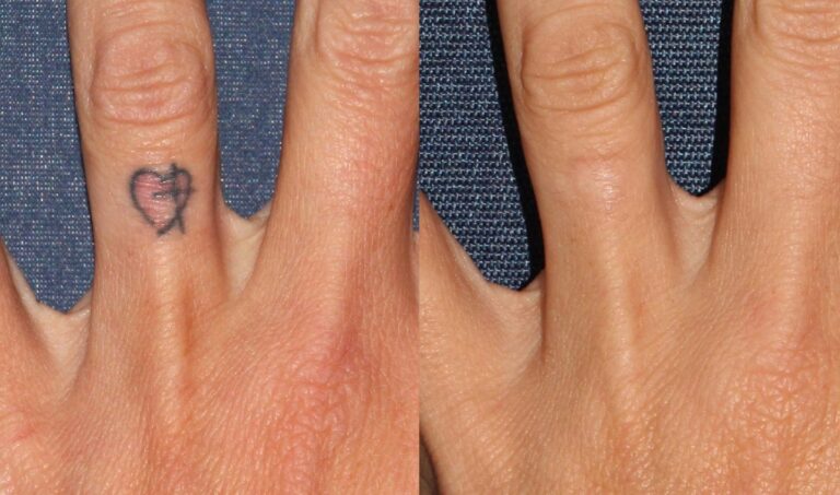 Before and after front image of laser tattoo removal treatment on a female's finger performed by Dr. Groff at our San Diego medical spa