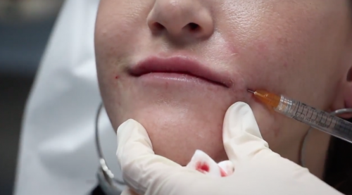 patient getting a cosmetic injectable