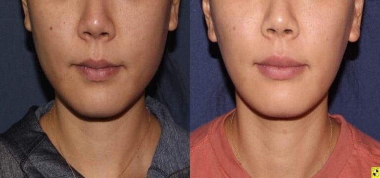 Before and after front image of Botox treatment on a female's masseter muscles performed by Dr. Boen at our San Diego medi spa
