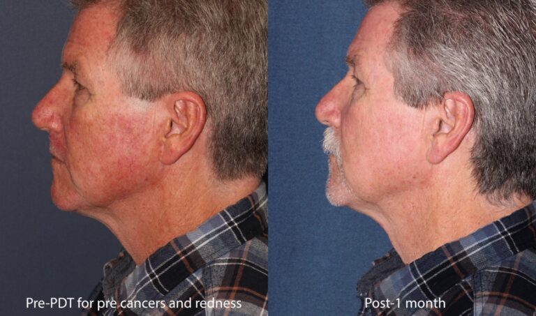 Before and after side image of photodynamic therapy on a male's face performed by Dr. Butterwick at our San Diego medical clinic