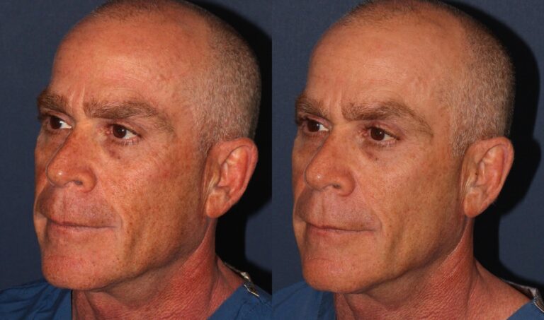 Before and after oblique image of Fraxel and PicoWay treatment on a male's face performed by Dr. Wu at our San Diego medical spa
