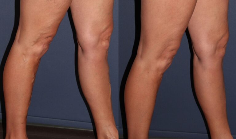 Before and after side image of foam sclerotherapy treatment on a female's leg performed by Dr. Goldman at our San Diego medical spa