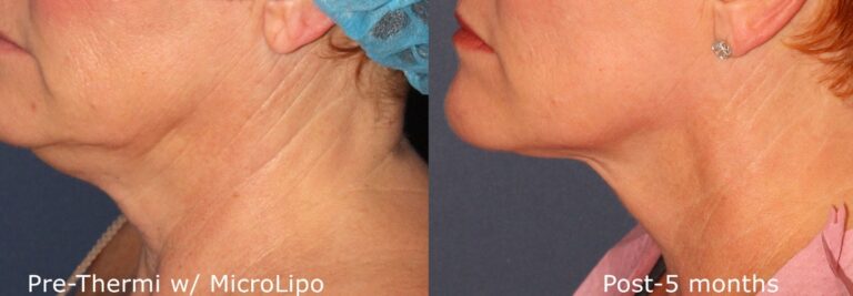 Before and after side image of liposculpture and ThermiTight treatment on a female's chin performed by Dr. Wu at our San Diego medical spa