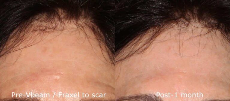 Before and after front image of Vbeam and Fraxel treatment on a female's forehead performed by Dr. Groff at our San Diego medi spa