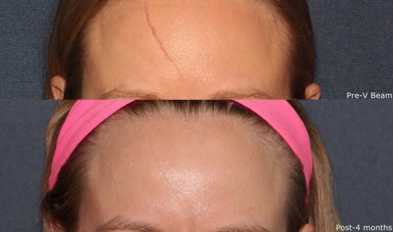 Before and after front image of Vbeam treatment on a female's forehead performed by Dr. Wu at our San Diego medical spa
