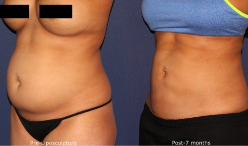 Before and after oblique image of liposculpture treatment on a female's abdomen performed by Dr. Wu at our San Diego medical spa