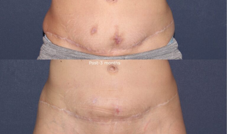 Before and after front image of Vbeam and Fraxel Dual treatment on a female's abdomen performed by Dr. Wu at our San Diego medical spa
