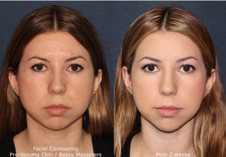 Before and after front image of Voluma and Botox treatment on a female's face performed by Dr. Fabi at our San Diego medical spa