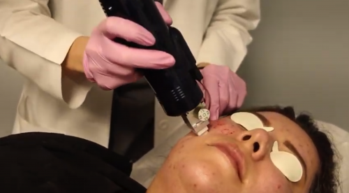 cosmetic laser dermatology doctor treating patient with rf microneedling san diego ca