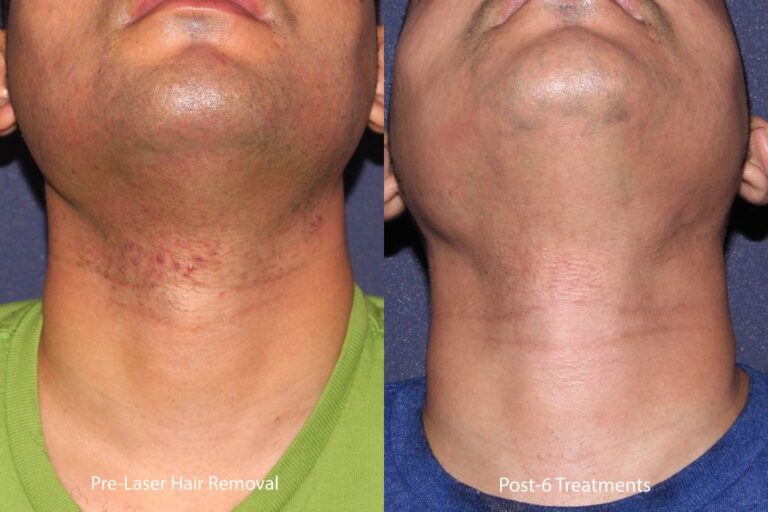 Before and after front image of laser hair removal treatment on a male's chin and neck performed by Leysin Fletcher, PA-C, at our San Diego medical spa