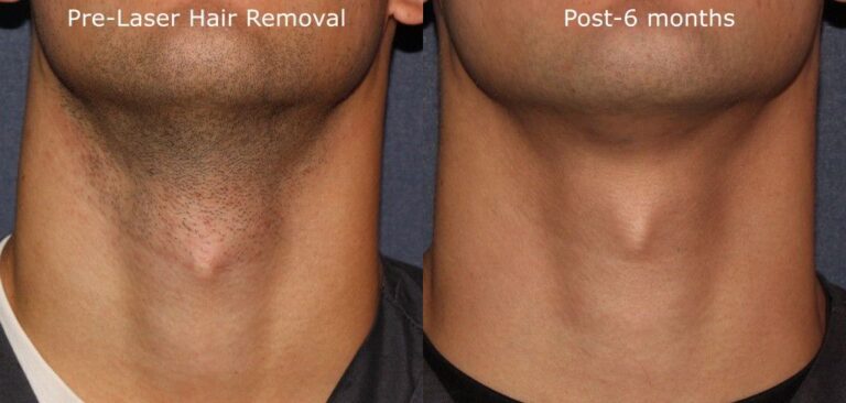 Before and after front image of laser hair removal treatment on a male's chin and neck performed by Leysin Fletcher, PA-C, at our San Diego medical clinic