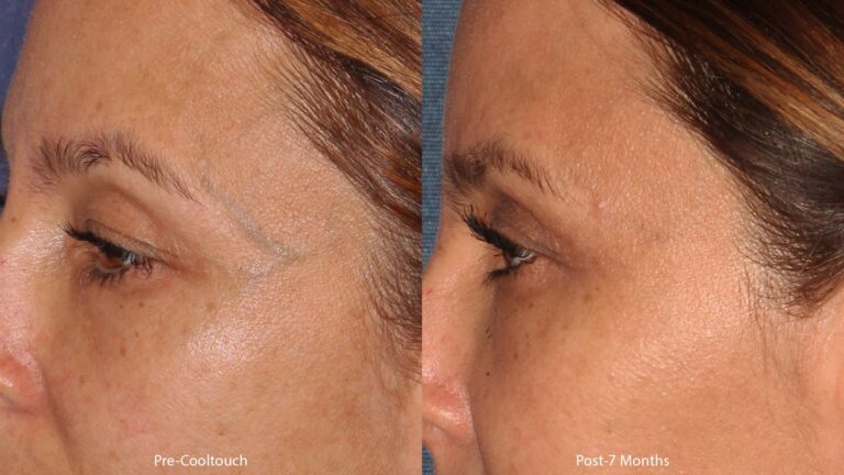 Before and after side image of CoolTouch Varia treatment on a female's veins near the eyes performed by Dr. Wu at our San Diego medical spa