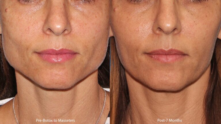 Before and after front image of Botox treatment on a female's masseter muscles performed by Dr. Wu at our San Diego medical clinic