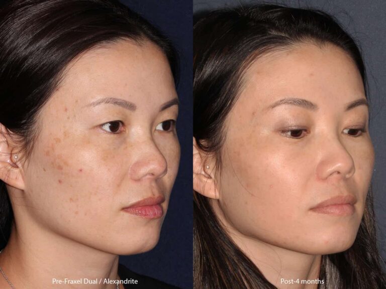 Before and after oblique image of Fraxel Dual and Alexandrite laser treatment on a female's face performed by Dr. Groff at our San Diego medical clinic