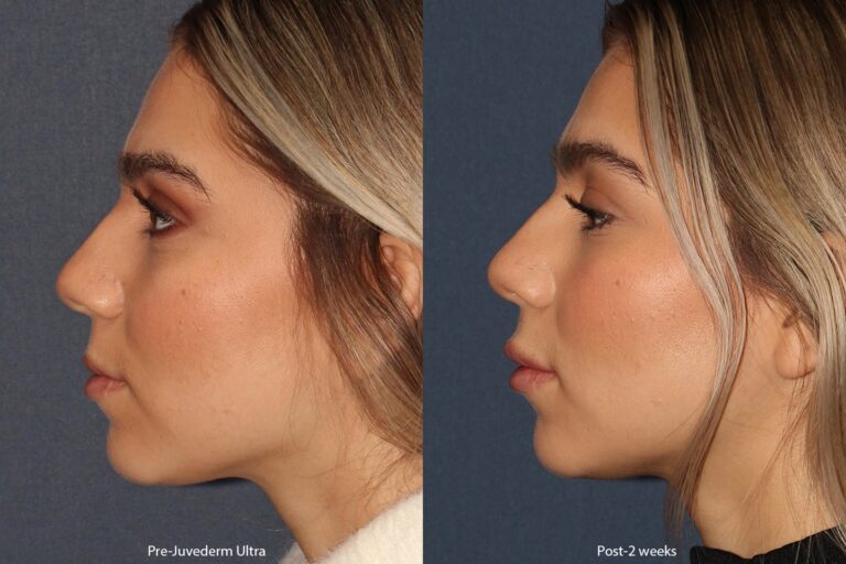 Before and after side image of Juvederm treatment on a female's lips performed by Dr. Boen at our San Diego medi spa