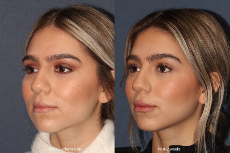 Before and after oblique image of Juvederm treatment on a female's lips performed by Dr. Boen at our San Diego medical clinic