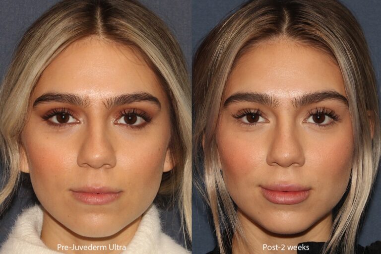 Before and after front image of Juvederm treatment on a female's lips performed by Dr. Boen at our San Diego medical clinic
