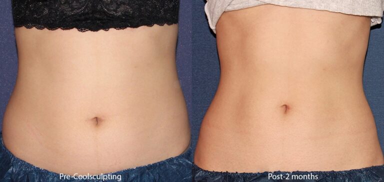 Before and after front image of CoolSculpting treatment on a female's abdomen performed by Leysin Fletcher, PA-C, at our San Diego medical clinic