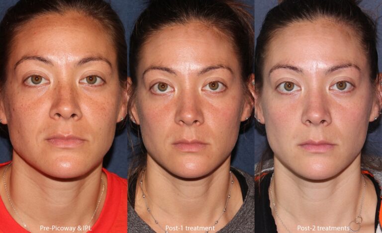 Before and after front image of IPL and PicoWay laser treatment on a female's face performed by Dr. Wu at our San Diego medi spa
