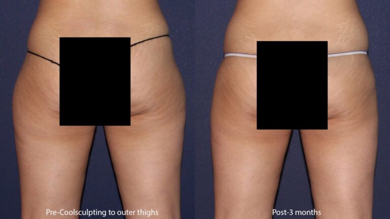 Before and after back image of CoolSculpting treatment on a female's hips, flanks, and thighs performed by Leysin Fletcher, PA-C, at our San Diego medical spa