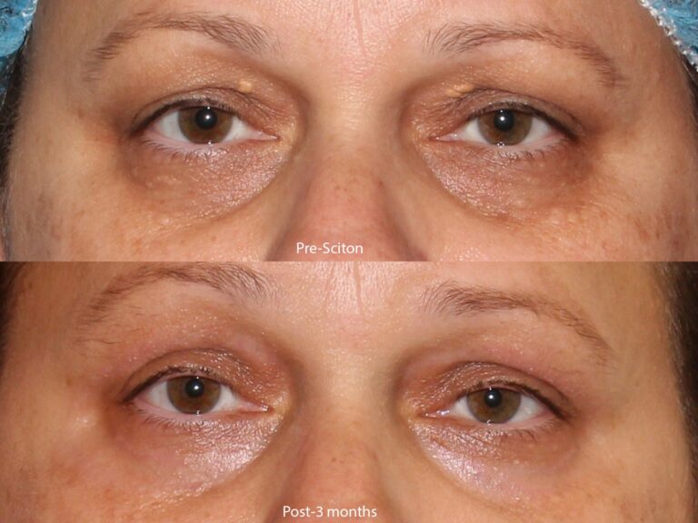 Before and after front image of Sciton laser treatment on a female's area under the eyes performed by Dr. Goldman at our San Diego medical spa