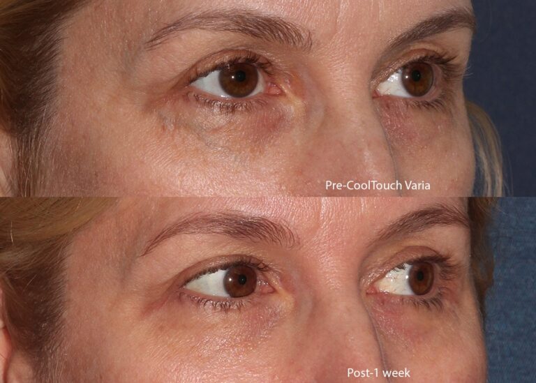 Before and after oblique image of CoolTouch Varia treatment on a female's veins near the eye performed by Dr. Groff at our San Diego medical spa