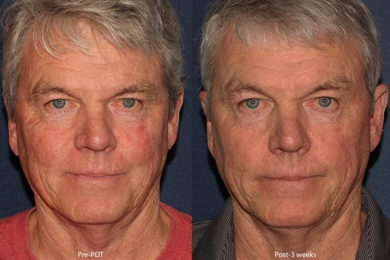 Before and after front image of photodynamic therapy on a male's face performed by Dr. Wu at our San Diego medical spa