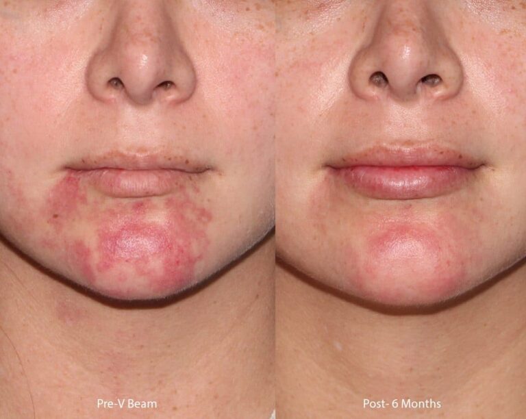 Before and after front image of Vbeam treatment on a female's chin performed by Dr. Groff at our San Diego medical clinic