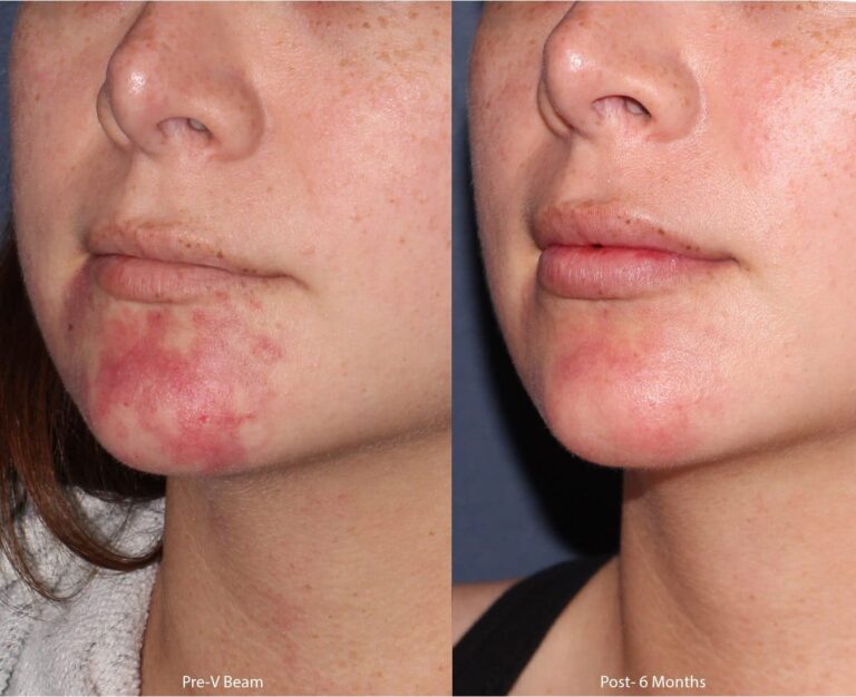 Before and after oblique image of Vbeam treatment on a female's chin performed by Dr. Groff at our San Diego medical clinic