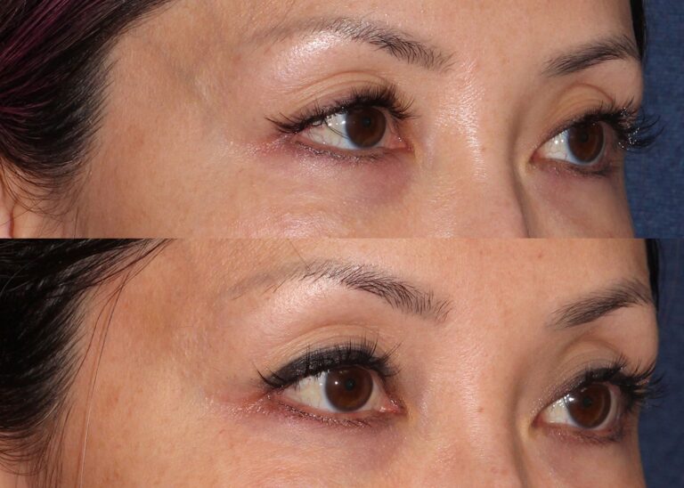 Before and after oblique image of CoolTouch Varia treatment on a female's veins near the eye performed by Dr. Fabi at our San Diego medical spa