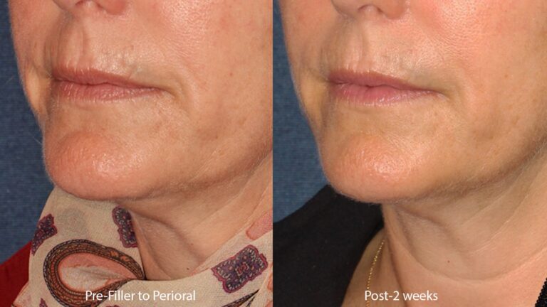 Before and after oblique image of Restylane treatment on a female's mouth performed by Dr. Butterwick at our San Diego medical clinic