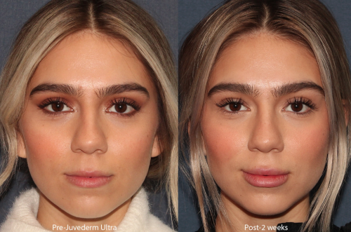 Before and After photo of lip injectables of a San Diego patient. 