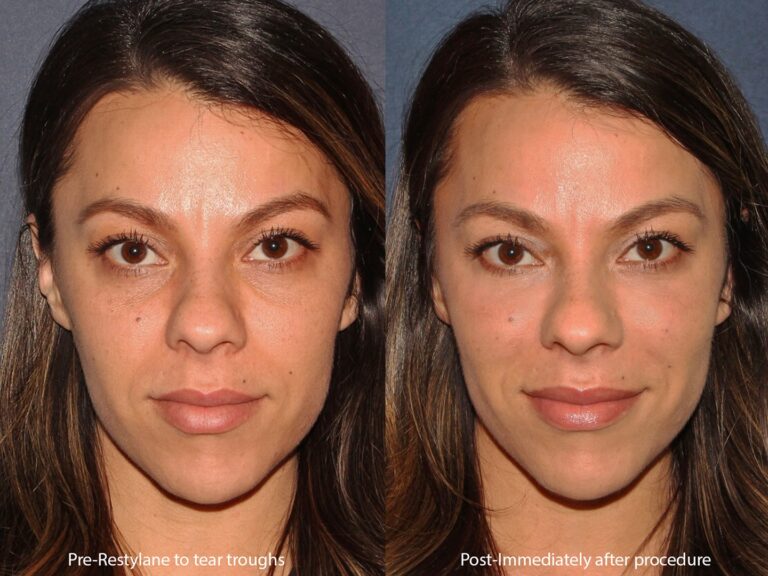 Before and after front image of Restylane treatment on a female's tear troughs performed by Dr. Butterwick at our San Diego medical spa