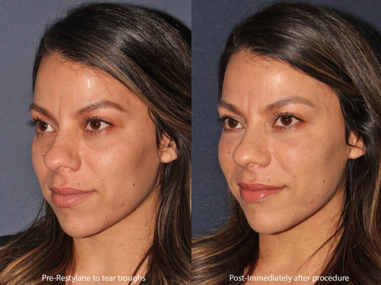 Before and after oblique image of Restylane treatment on a female's tear troughs performed by Dr. Butterwick at our San Diego medical spa