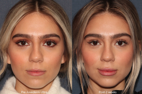 Juvederm FillerTreatment Before and After Results in San Diego, CA