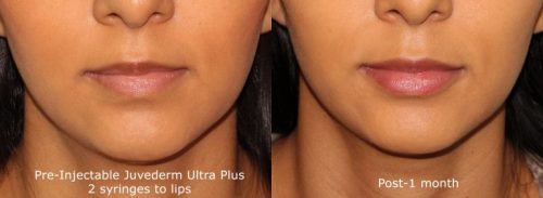 Lip Filler Injection Results in San Diego, CA