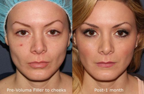 Voluma Cheek Filler Before and After in San Diego, CA