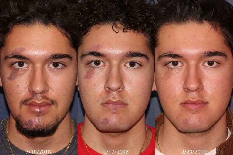 Before and after front image of Cynergy and PicoWay treatment on a male's face performed by Dr. Goldman at our San Diego medi spa