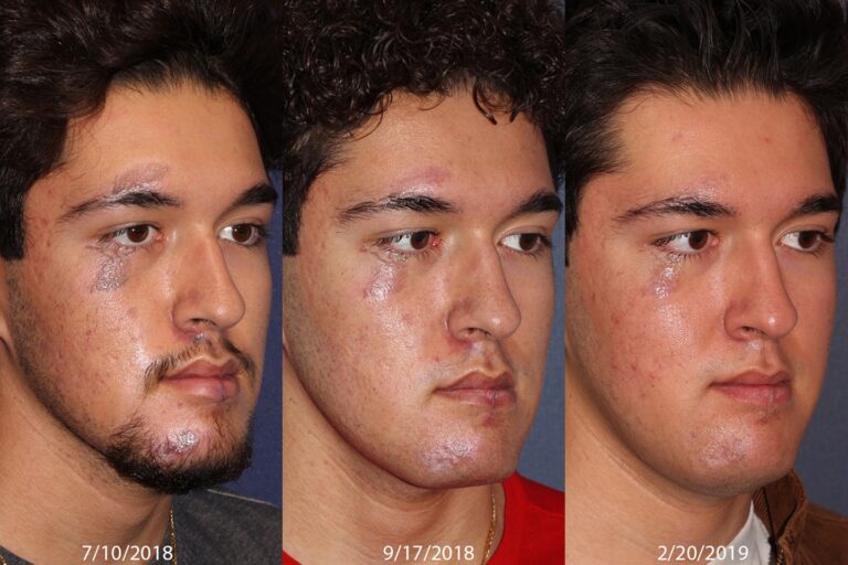 Before and after oblique image of Cynergy and PicoWay treatment on a male's face performed by Dr. Goldman at our San Diego medi spa