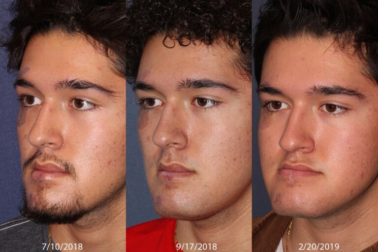 Before and after oblique image of Cynergy and PicoWay treatment on a male's face performed by Dr. Goldman at our San Diego medi spa